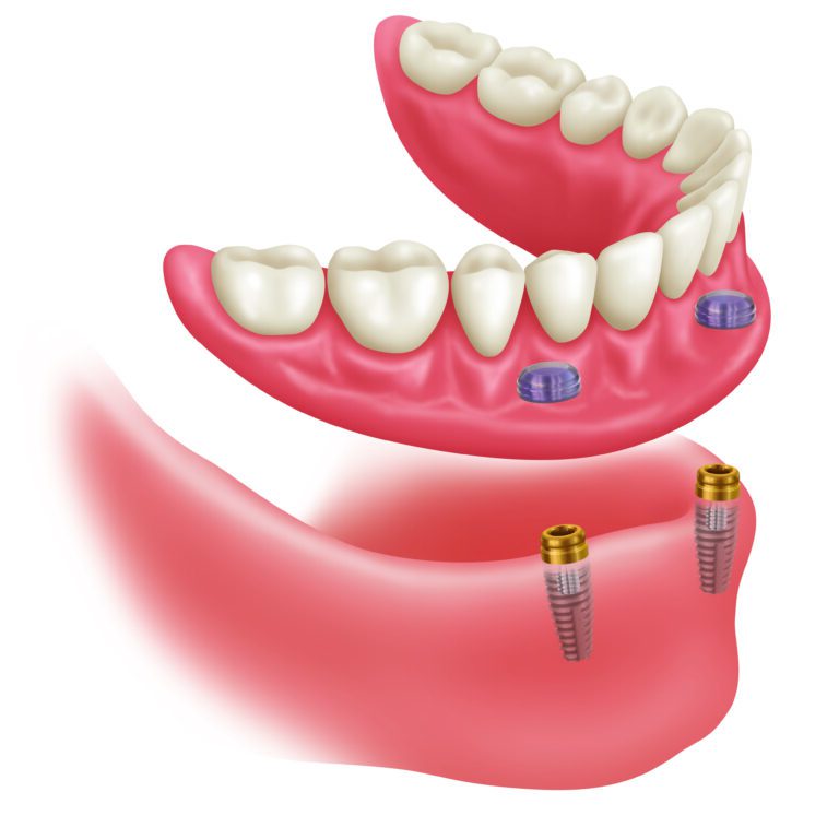 Implantate für zahnlose Kiefer - Zahnarztpraxis Dr. Moritz Weber